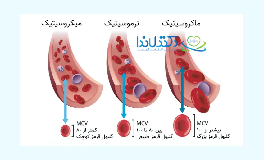 نمای شماتیک سه وضعیت MCV: میکروسیتیک (کمتر از ۸۰ fL)، نرموسیتیک (۸۰ تا ۱۰۰ fL) و ماکروسیتیک (بیشتر از ۱۰۰ fL) که اندازه گلبولهای قرمز را در شرایط مختلف کمخونی نشان میدهد