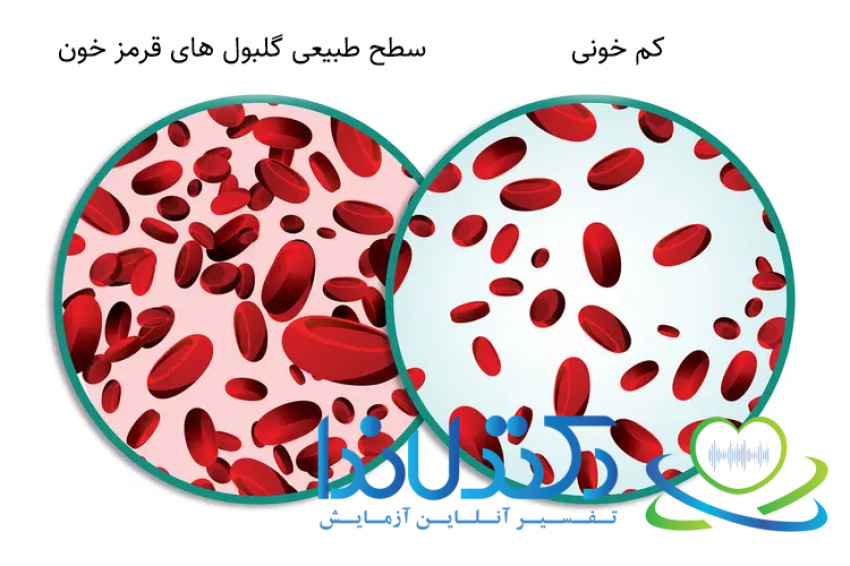 «مقایسه سطح طبیعی گلبولهای قرمز خون با وضعیت کمخونی؛ آزمایش MCV به شناسایی این تغییرات و تعیین نوع کمخونی کمک میکند.»