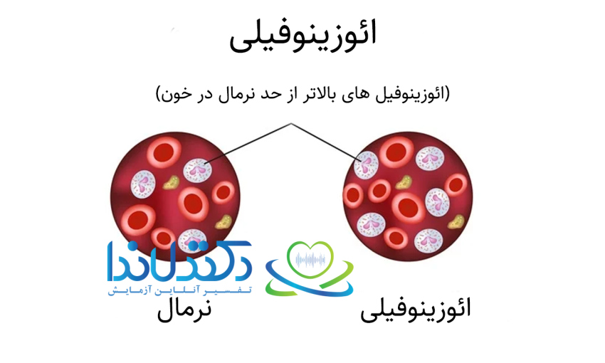 مقایسه وضعیت نرمال و ائوزینوفیلی (Eosinophilia) — در ائوزینوفیلی تعداد ائوزینوفیلها (Eosinophils) در خون بیش از حد نرمال است، که میتواند نشانه واکنش آلرژیک، عفونت انگلی یا بیماریهای ایمنی باشد.