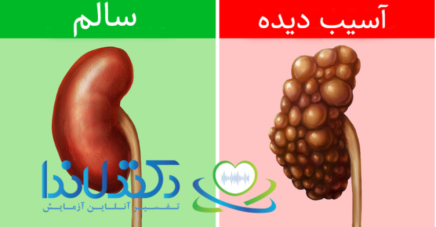 در تصویر، کلیه سمت چپ سالم و کلیه سمت راست دچار آسیب شدید ناشی از نارسایی کلیه دیده میشود