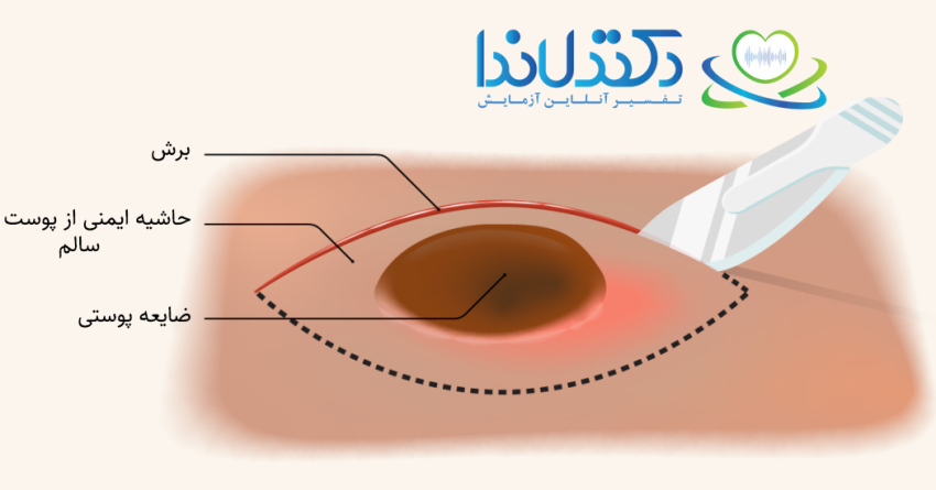 در بیوپسی خارج‌سازی، کل ضایعه پوستی همراه با برش و حاشیه ایمنی از پوست سالم برداشته می‌شود تا احتمال باقی‌ماندن سلول‌های غیرطبیعی به حداقل برسد. این تکنیک یکی از روش‌های استاندارد برای تشخیص ضایعات مشکوک به سرطان پوست است.