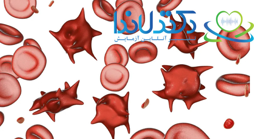 تصویر گلبول‌های قرمز طبیعی و غیرطبیعی در خون فرد مبتلا به poikilocytosis؛ سلول‌های دارای شکل نامنظم می‌توانند نشانه بیماری‌های خونی یا وضعیت خاص بدن باشند.