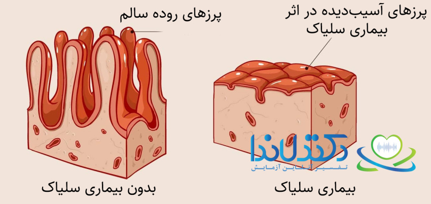 تفسیر آزمایش سلیاک