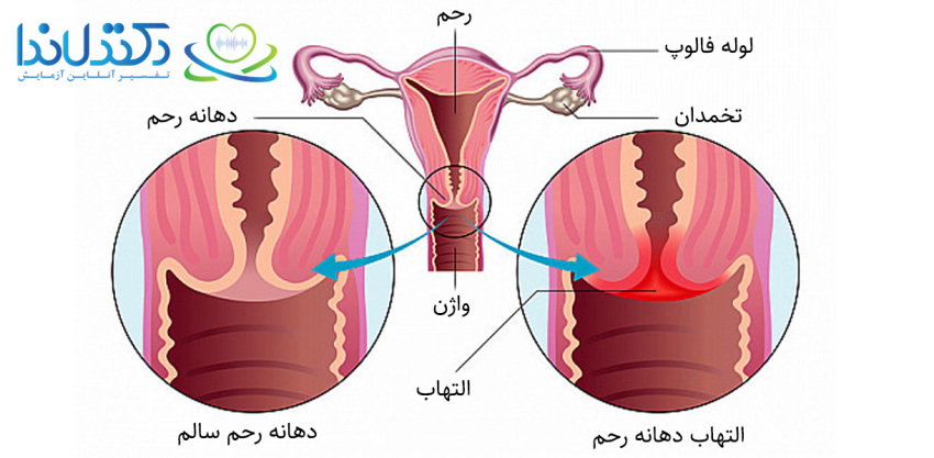 التهاب moderate در پاپ اسمیر