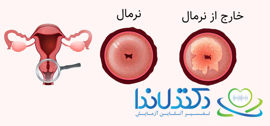 Pap smear test result