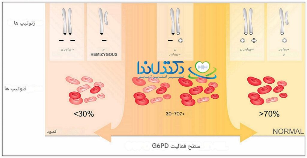 سطح فعالیت G6PD