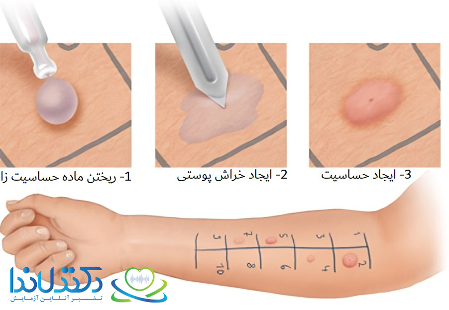 مراحل تست آلرژی