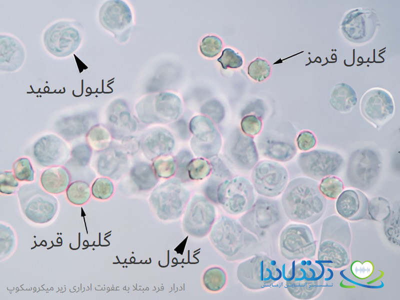 گلبول سفید و قرمز در آزمایش ادرار فرد مبتلا به عفونت ادراری دکتر لاندا متخصص تفسیر آزمایش