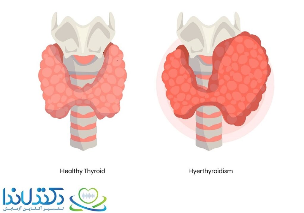 Hyperthyroidism