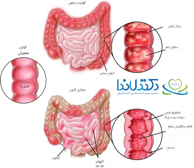 IBD