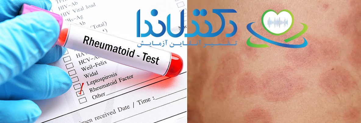 آزمایش روماتیسم