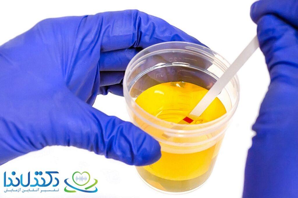 تفسیر آزمایش urine analysis