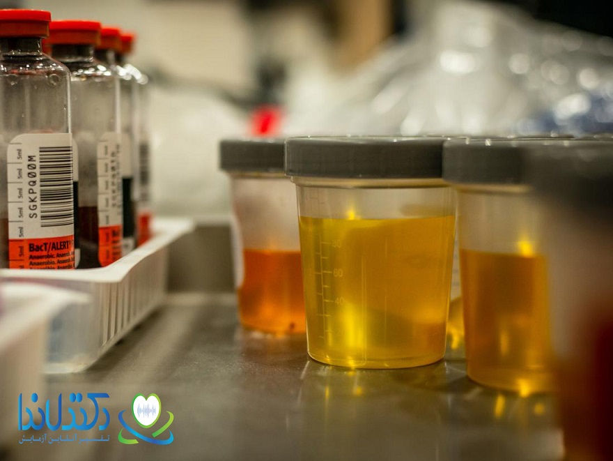 تفسیر آزمایش urine analysis