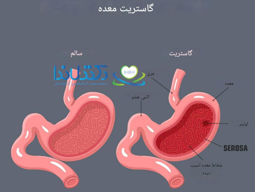 آسیب دیواره معده