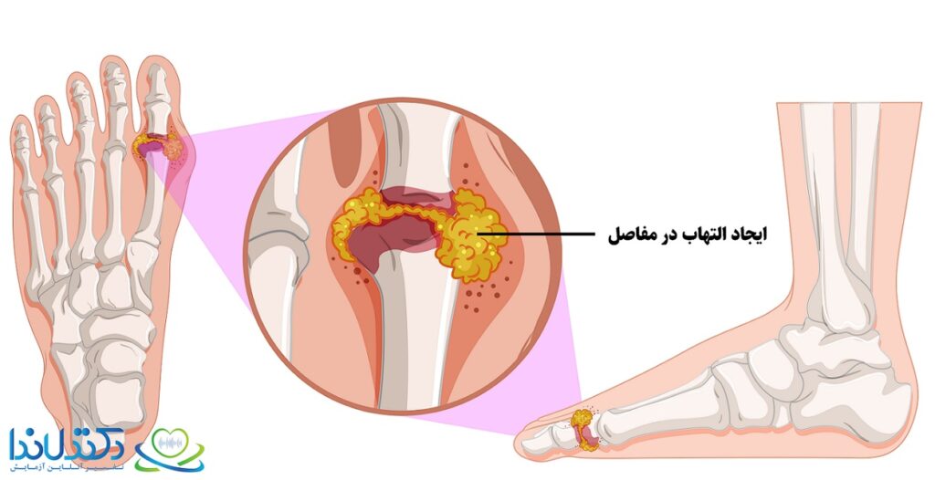 تفسیر آزمایش آنتی سی سی پی