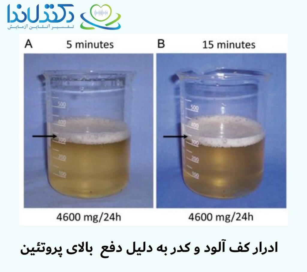 تفسیر آزمایش دفع پروتئین دکتر لاندا