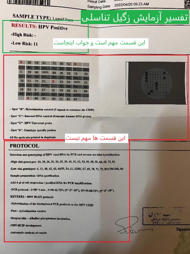 تفسیر آزمایش زگیل تناسلی دکتر لاندا