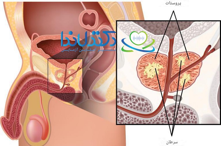 خواندن جواب آزمایش پروستات