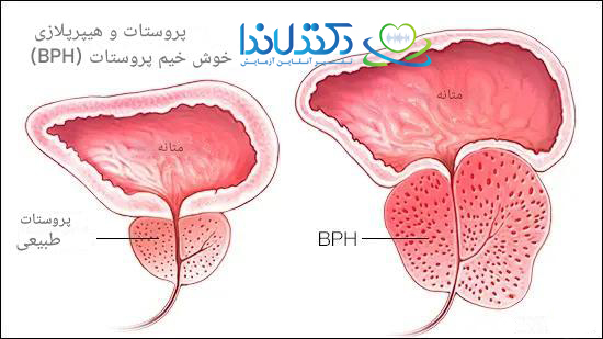 خواندن جواب آزمایش پروستات