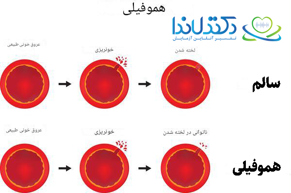 هموفیلی