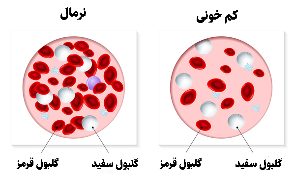 کم خونی