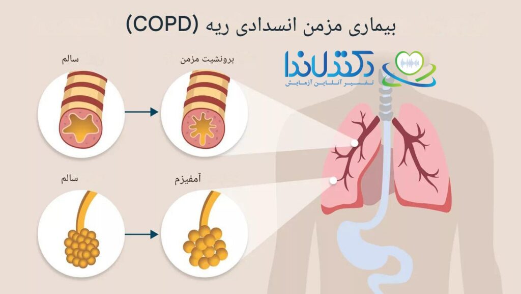 COPD