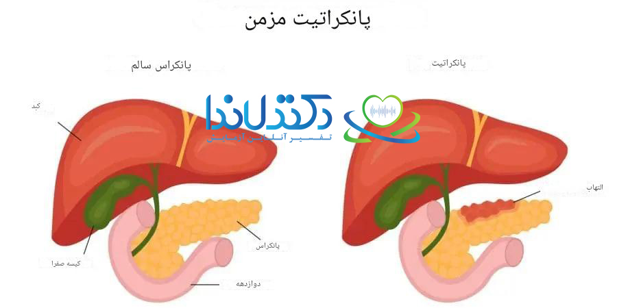 پانکراتیت مزمن