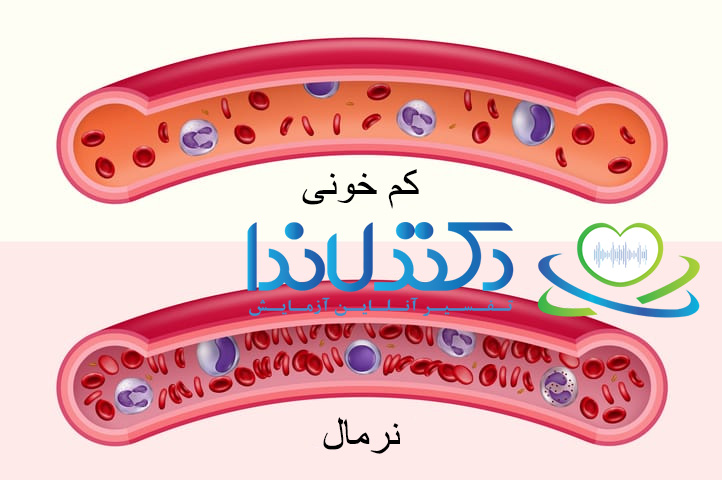 مقایسه گلبول های قرمز طبیعی و کم خونی