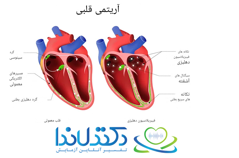 آریتمی قلبی