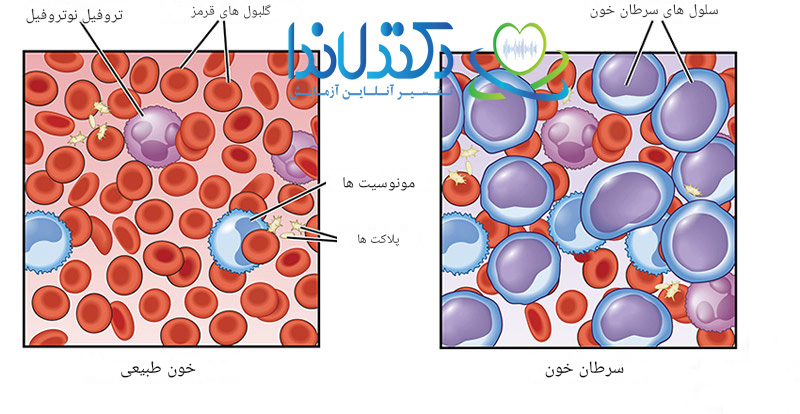 خون طبیعی-سرطان خون