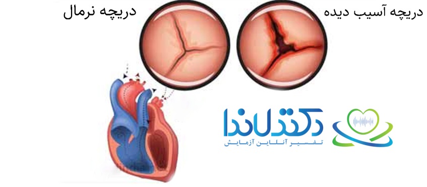 دریچه سالم و آسیب دیده