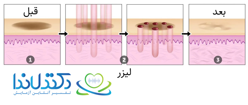 عملکرد لیزر در کاهش تیرگی و تحریک تولید کلاژن ناحیه تناسلی
