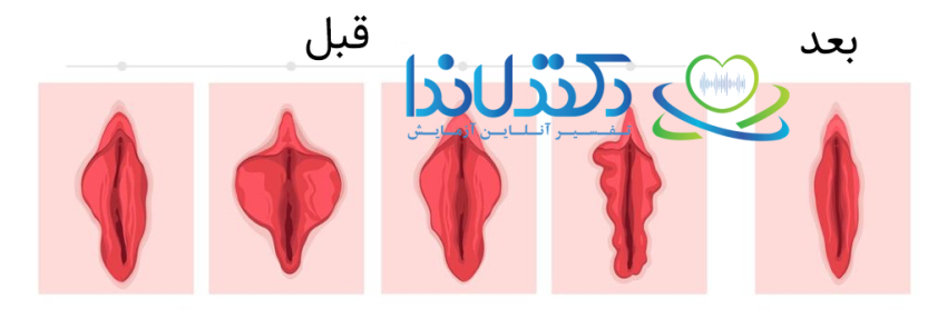 تصویر قبل و بعد از جراحی لابیاپلاستی برای اصلاح نامتقارن بودن و رفع برجستگی لبهای واژن