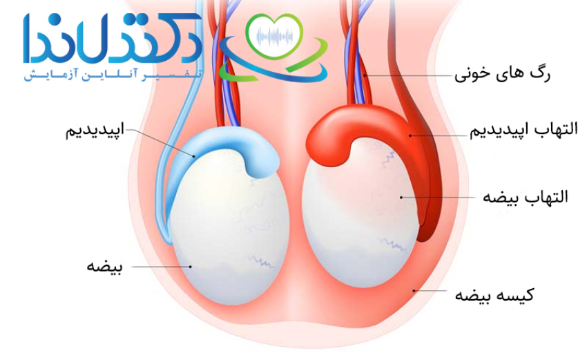 التهاب و عفونت بیضه و اپیدیدیم باعث تورم و درد در کیسه بیضه می‌شود؛ تشخیص و درمان به‌موقع اهمیت بالایی دارد.