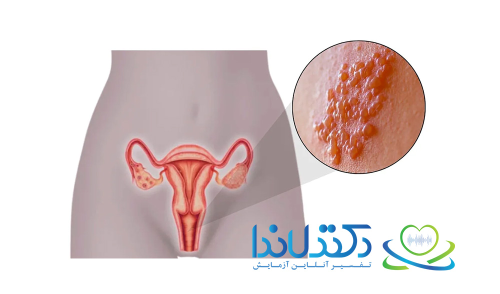 تبخال ناحیه تناسلی