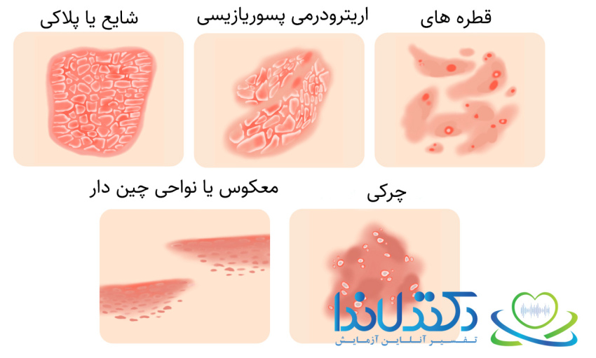 شکل‌های مختلف پسوریازیس: از پلاکی و قطره‌ای تا نوع در نواحی چین‌دار و چرکی. تشخیص صحیح نوع بیماری برای درمان موثر ضروری است.
