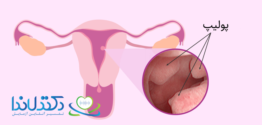 اولین پریودی بعد از عمل پولیپ رحم