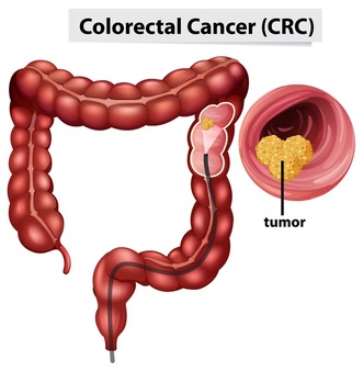 colorectal-cancer-crc-infographic-education_1308-47971