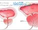 خواندن جواب آزمایش پروستات